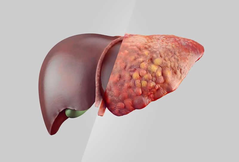 Gordura no fígado: saiba mais sobre o diagnóstico e tratamento