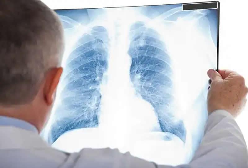 Diagnóstico e exames relacionados a pneumonia e pneumonite