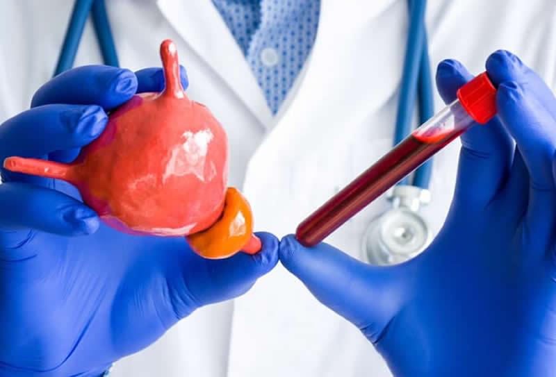Exames complementares para detectar Câncer de Próstata