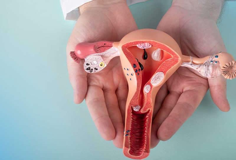 Para diagnóstico da Endometriose: quais exames fazer?