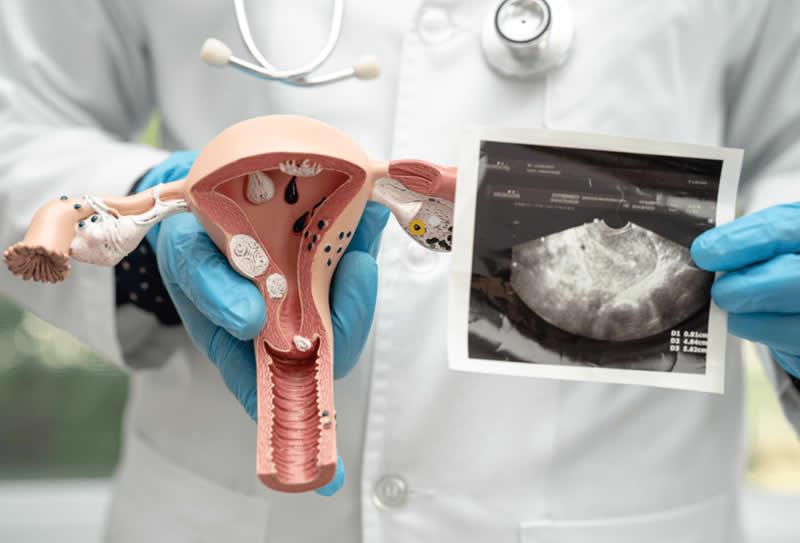 Exame de Imagem para diagnosticar SOP